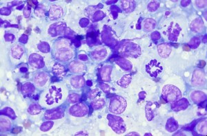 Disseminated Lymphoma