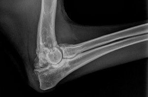 Osteoarthritis of the elbow (dysplasia)